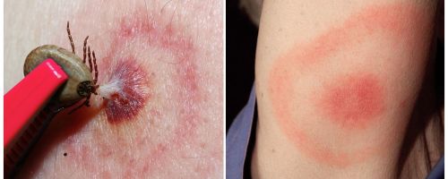 O que é a doença de Lyme, seus sintomas, tratamento e foto